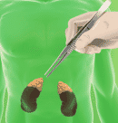 kidney-transplant-sets-image-small