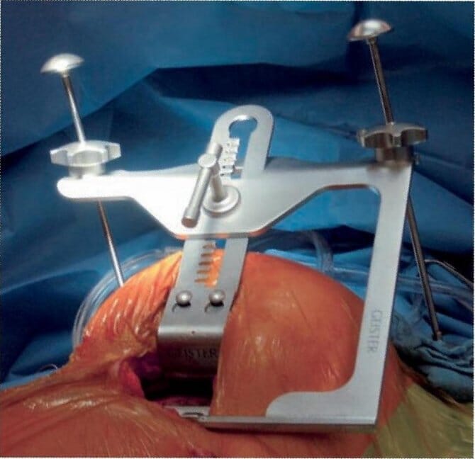 minimally-invasive-direct-coronary-artery-bypass-midcab-retractor-product-image-header